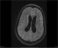 Brainstem glioma (Radiopaedia 21819-21775 Axial FLAIR 25).jpg