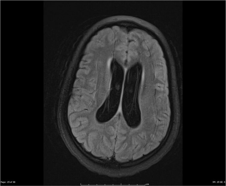 File:Brainstem glioma (Radiopaedia 21819-21775 Axial FLAIR 25).jpg
