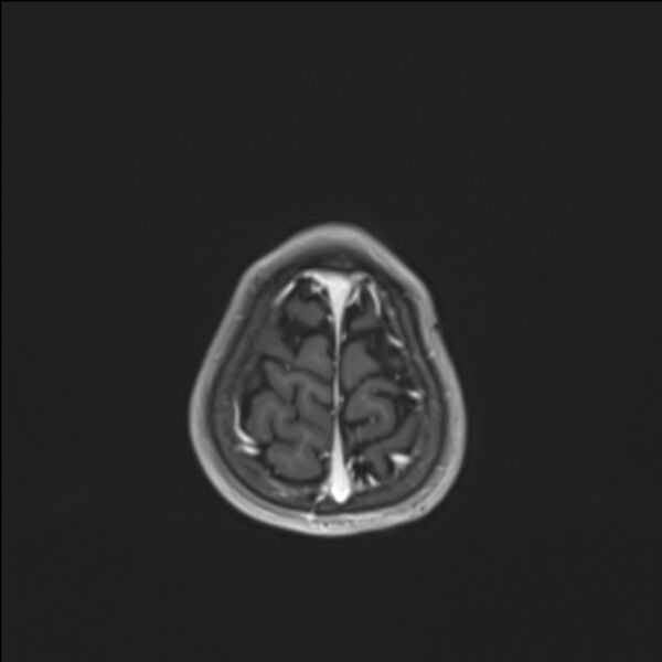 File:Brainstem glioma (Radiopaedia 70548-80674 Axial T1 C+ 142).jpg