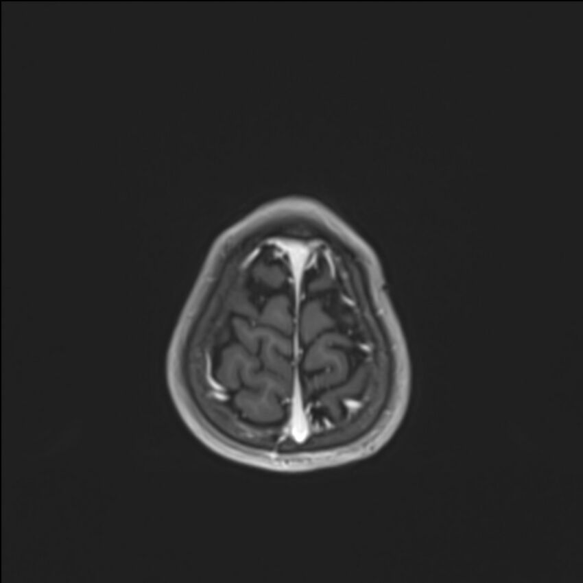 Brainstem glioma (Radiopaedia 70548-80674 Axial T1 C+ 142).jpg