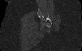 Breast carcinoma with pathological hip fracture (Radiopaedia 60314-67993 Coronal bone window 92).jpg