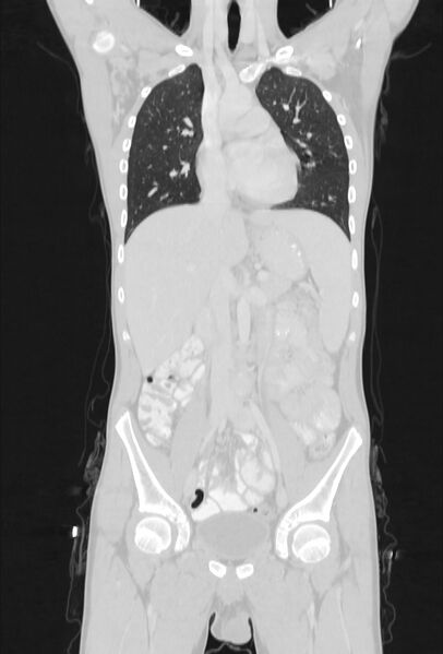 File:Bronchial carcinoid tumor (Radiopaedia 57187-64090 Coronal lung window 40).jpg
