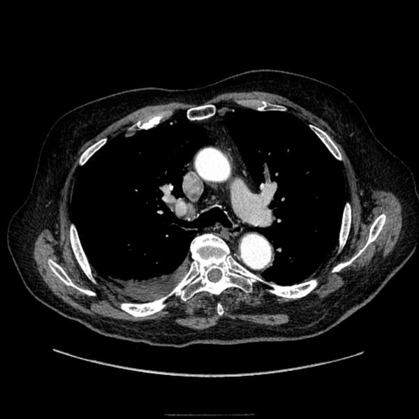 File:Bronchogenic adenocarcinoma and pulmonary embolism (Radiopaedia 9097-9806 D 27).jpg