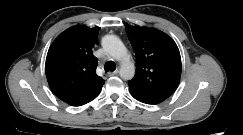 File:Bronchogenic carcinoma with superior vena cava syndrome (Radiopaedia 36497-38054 Axial C+ delayed 30).jpg