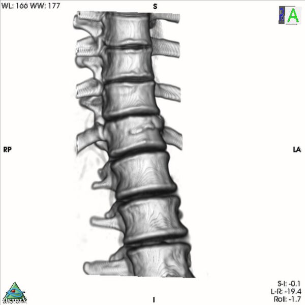 File:Bulging of paraspinal line in traumatic thoracal spinal compression fracture (Radiopaedia 29221-35872 3D VR 8).jpg