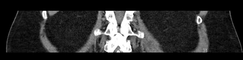 File:Buried bumper syndrome - gastrostomy tube (Radiopaedia 63843-72575 Coronal Inject 79).jpg