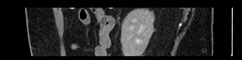 Buried bumper syndrome - gastrostomy tube (Radiopaedia 63843-72575 Sagittal Inject 27).jpg