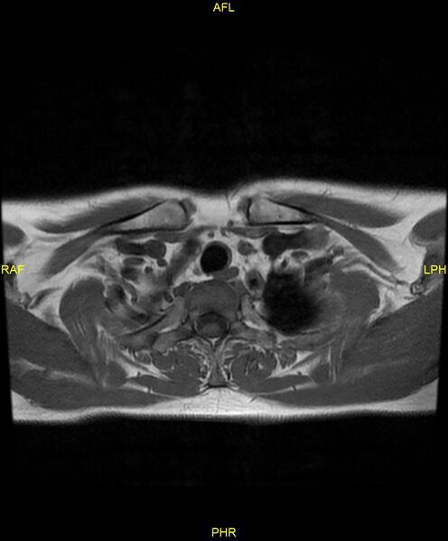 File:C5 nerve sheath tumor (Radiopaedia 85777-101596 Axial T1 26).jpg