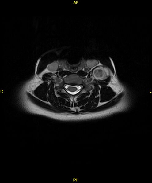 File:C5 nerve sheath tumor (Radiopaedia 85777-101596 Axial T2 43).jpg