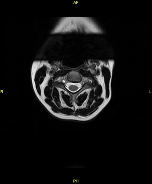 File:C5 nerve sheath tumor (Radiopaedia 85777-101596 Axial T2 5).jpg