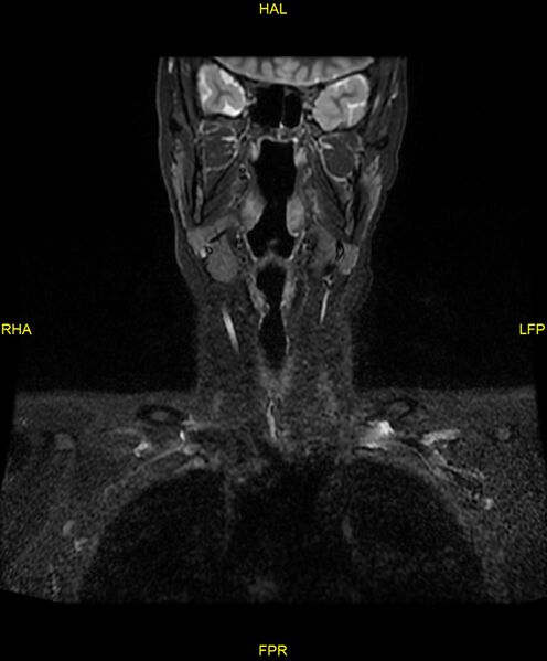 File:C5 nerve sheath tumor (Radiopaedia 85777-101596 Coronal T2 fat sat 3).jpg