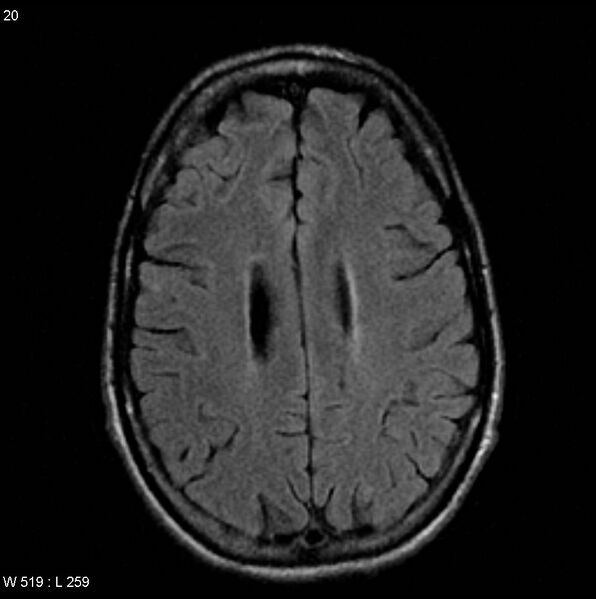 File:CMV ventriculitis and encephalitis (Radiopaedia 5416-7166 Axial FLAIR 8).jpg