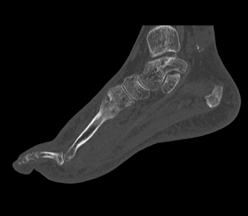 Calcaneal tuberosity avulsion fracture (Radiopaedia 22649-22668 Sagittal bone window 31).jpg