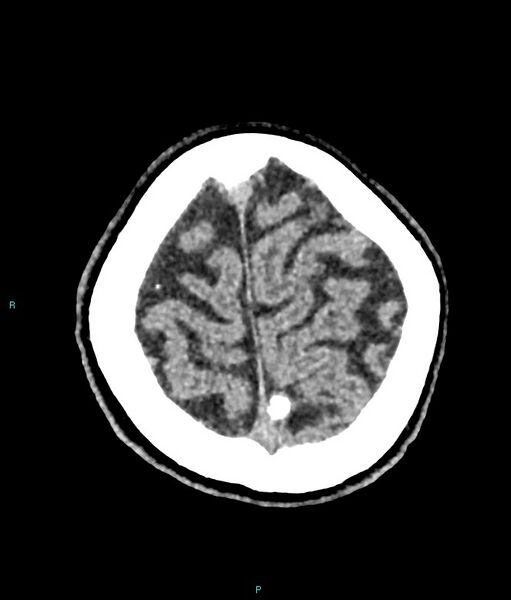 File:Calcified cerebral emboli from left ventricular thrombus (Radiopaedia 84420-99758 Axial non-contrast 15).jpg