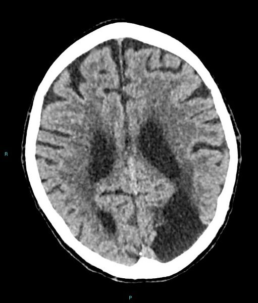 File:Calcified cerebral emboli from left ventricular thrombus (Radiopaedia 84420-99758 Axial non-contrast 36).jpg
