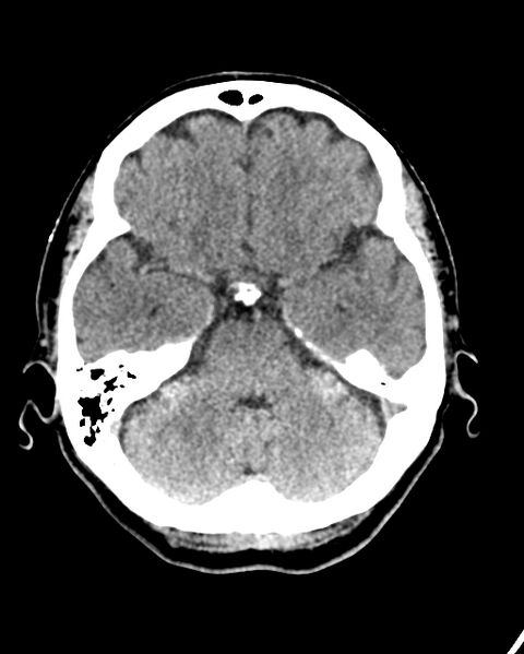 File:Calcified meningioma (Radiopaedia 74361-85243 Axial non-contrast 36).jpg