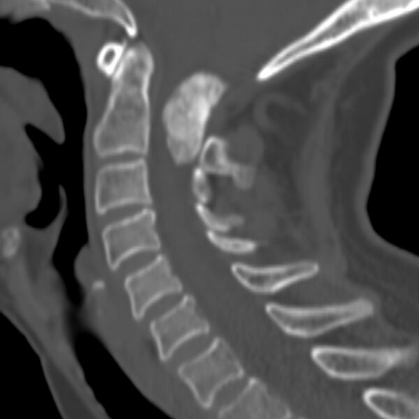 File:Calcified meningioma - cervical canal (Radiopaedia 70136-80171 Sagittal bone window 14).jpg