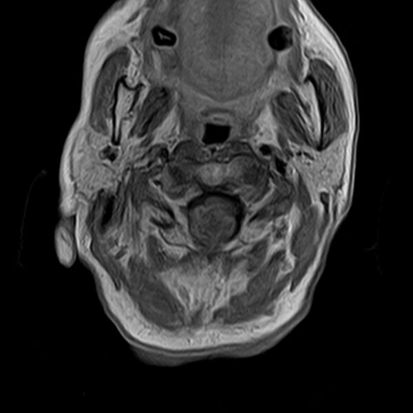 File:Calcified meningioma - cervical canal (Radiopaedia 70136-82468 Axial T1 C+ 8).jpg