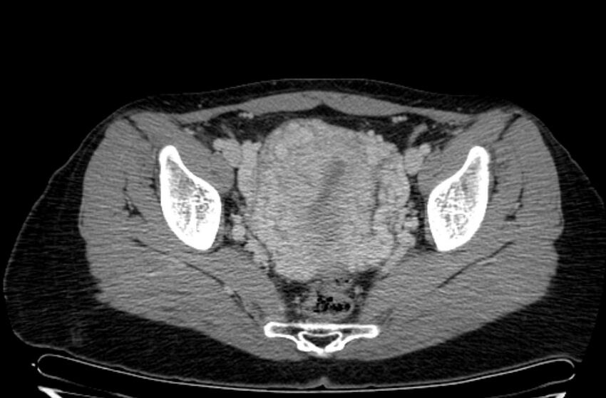 Cannonball metastases - uterine choriocarcinoma (Radiopaedia 70137-80174 A 27).jpg