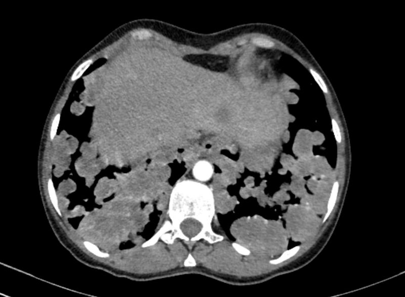 File:Cannonball metastases from breast cancer (Radiopaedia 91024-108569 A 101).jpg