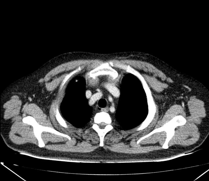 File:Carcinoid tumor with hepatic metastases (Radiopaedia 22651-22670 C 5).jpg