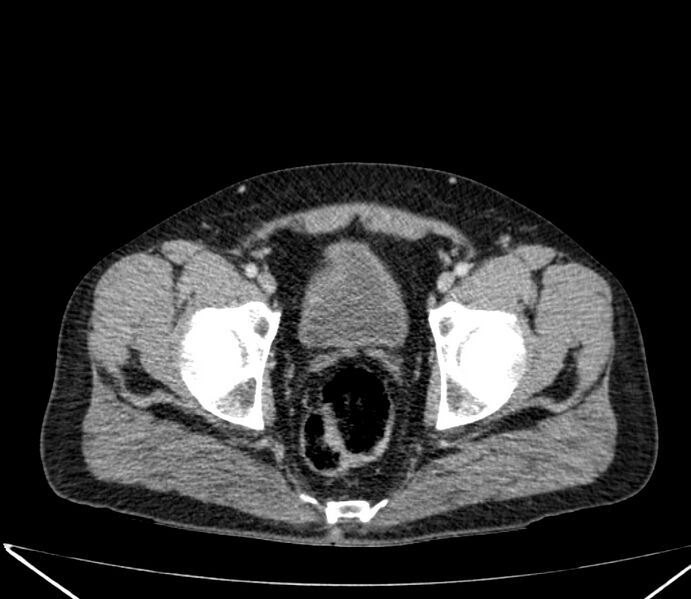 File:Carcinoid tumor with hepatic metastases (Radiopaedia 22651-22670 C 74).jpg