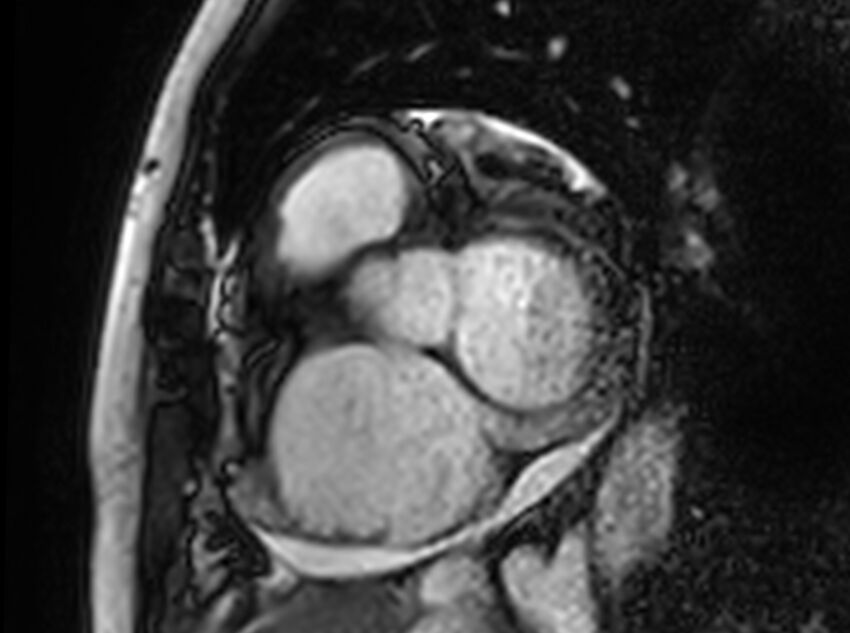 Cardiac amyloidosis (Radiopaedia 61600-69579 Short axis bSSFP 301).jpg