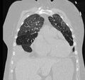 Cardiogenic pulmonary edema (Radiopaedia 29213-29609 Coronal lung window 21).jpg