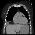 Cardiogenic pulmonary edema (Radiopaedia 29213-29609 Coronal non-contrast 12).jpg