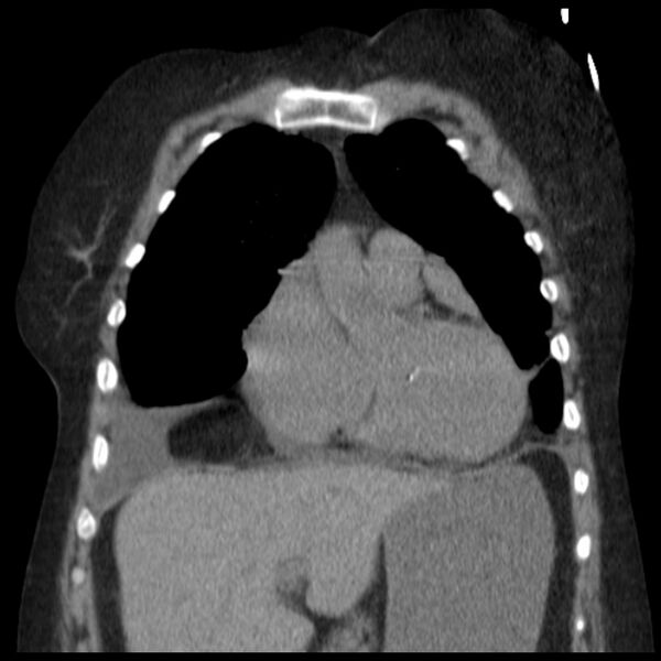 File:Cardiogenic pulmonary edema (Radiopaedia 29213-29609 Coronal non-contrast 12).jpg