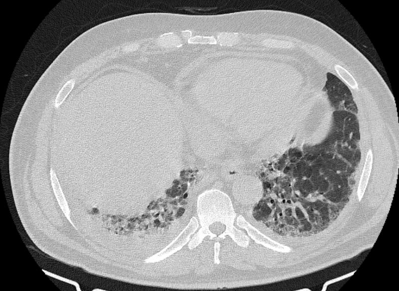 File:Cardiogenic pulmonary edema (Radiopaedia 68180-77678 Axial lung window 78).jpg