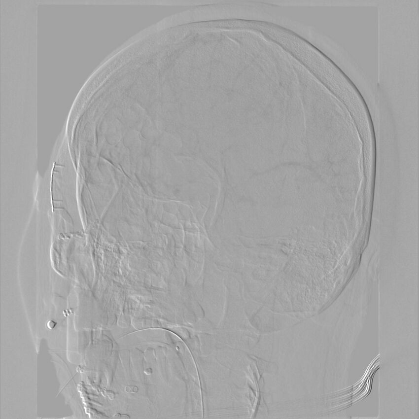 Caroticocavernous fistula - direct (Radiopaedia 61660-69666 Oblique Left ICA 51).jpg