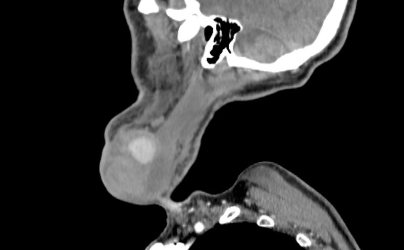 File:Carotid artery pseudoaneurysm (Radiopaedia 84030-99259 E 56).jpg