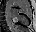 Caseous calcification of the mitral valve annulus (Radiopaedia 47717-52411 D 1).jpg