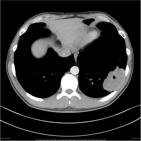 File:Cavitating lung cancer (Radiopaedia 25796-25945 C+ arterial phase 48).jpg