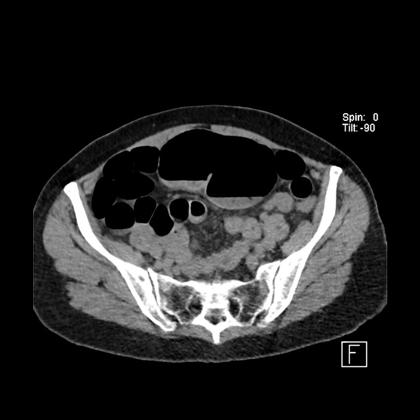 Cecal volvulus (Radiopaedia 90897-108397 Axial non-contrast 50).jpg