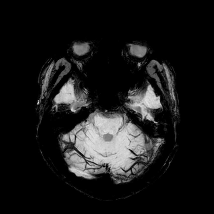 Central neurocytoma (Radiopaedia 79320-92380 Axial SWI 39).jpg