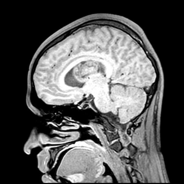 File:Central neurocytoma (Radiopaedia 79320-92380 Sagittal T1 117).jpg