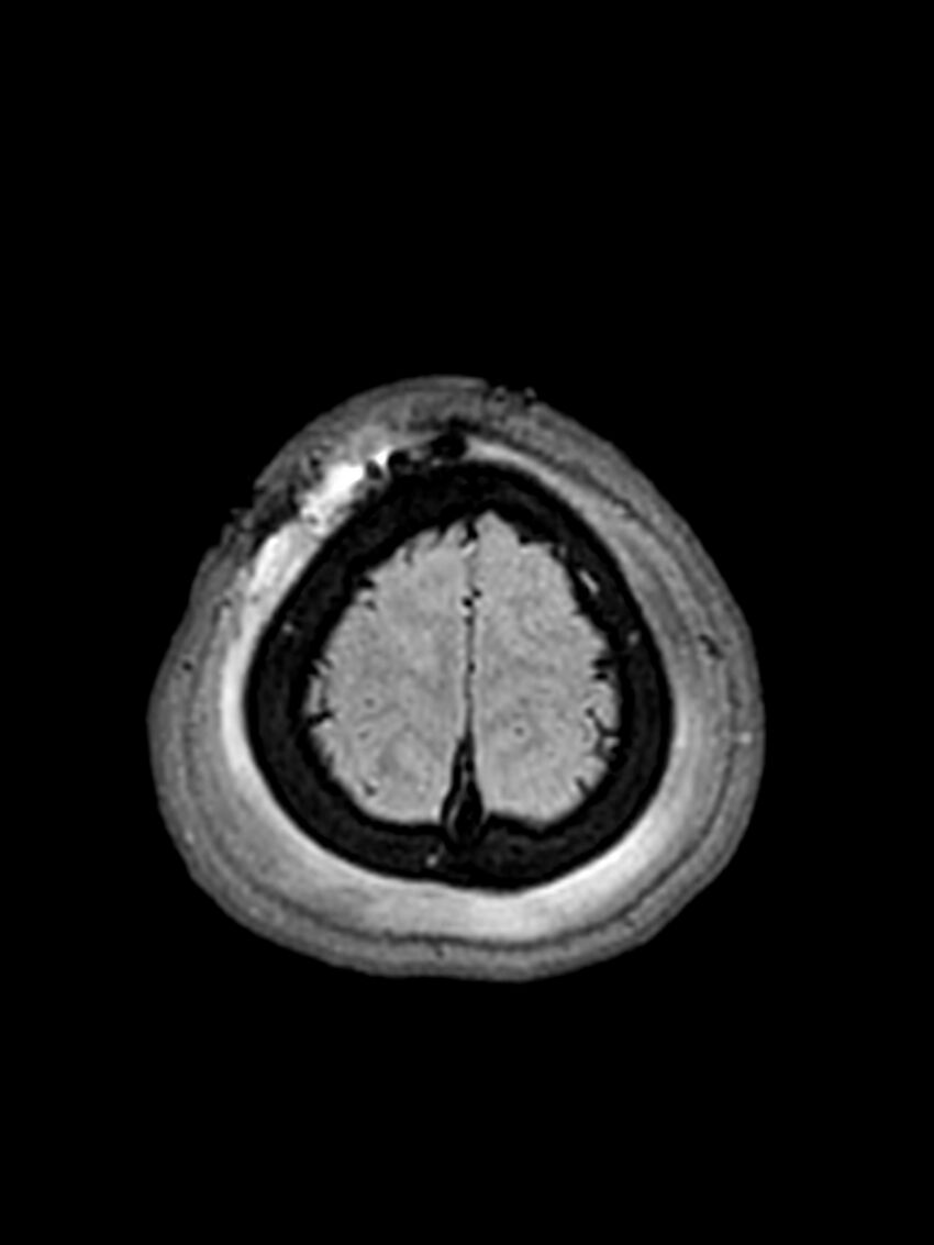 Central neurocytoma (Radiopaedia 79320-92381 Axial FLAIR 30).jpg