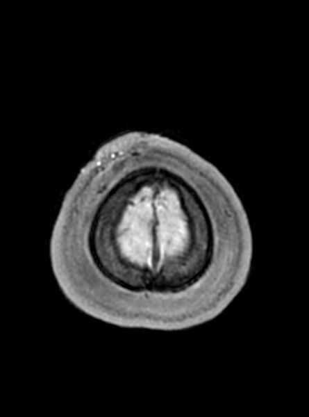 File:Central neurocytoma (Radiopaedia 79320-92381 Axial T1 50).jpg
