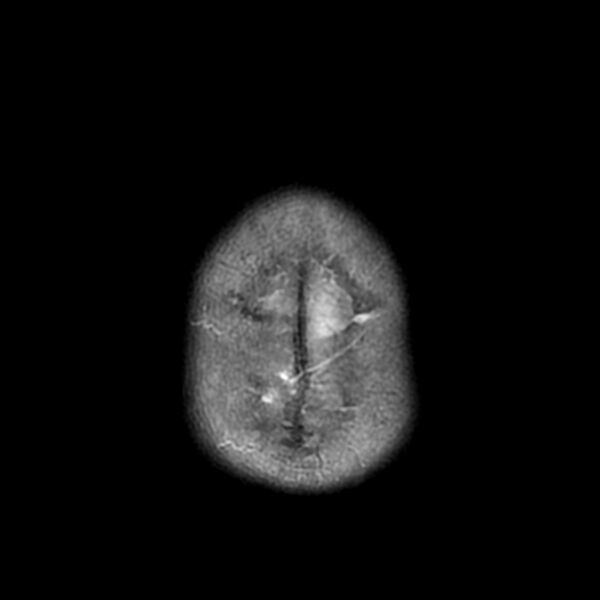 File:Cerebellar ataxia with neuropathy and vestibular areflexia syndrome (CANVAS) (Radiopaedia 74283-85159 Axial T2 21).jpg