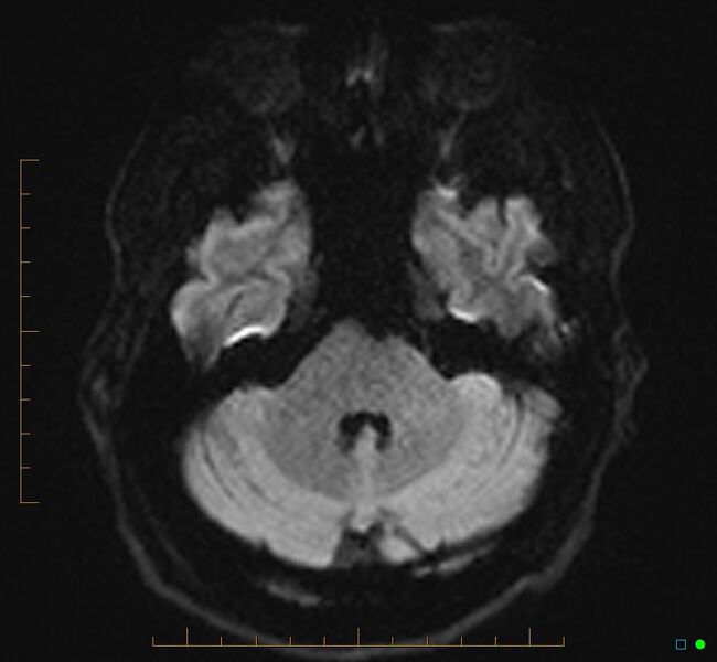 File:Cerebellar gangliocytoma (Radiopaedia 65377-74422 Axial DWI 10).jpg