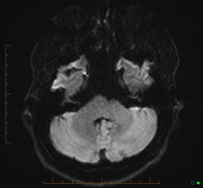 File:Cerebellar gangliocytoma (Radiopaedia 65377-74422 Axial DWI 9).jpg