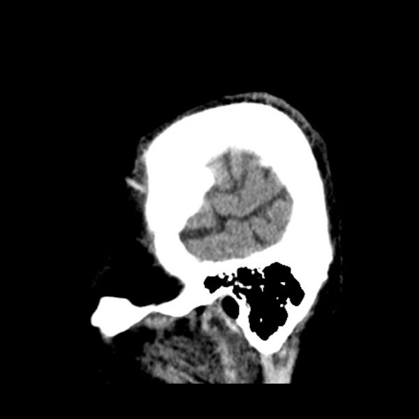 File:Cerebellar hemorrhage (Radiopaedia 27193-27359 C 5).jpg