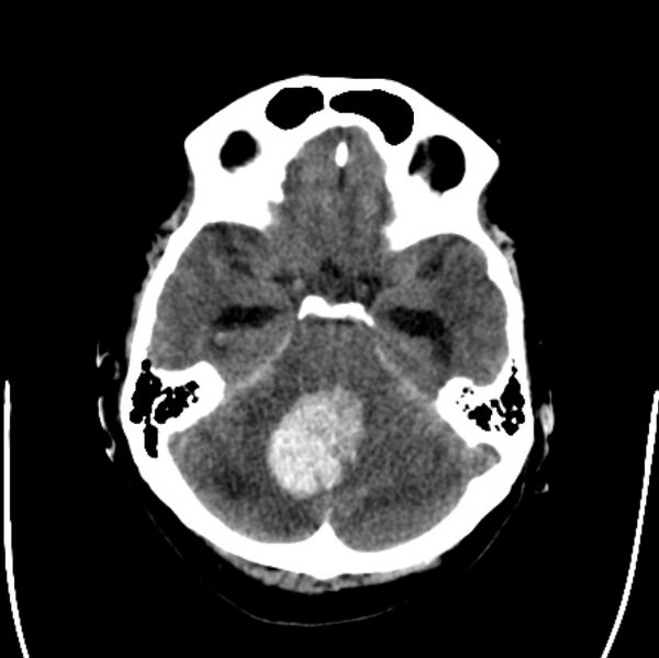 File:Cerebellar hemorrhage causing obstructive hydrocephalus (Radiopaedia 33989-35207 Axial non-contrast 15).jpg