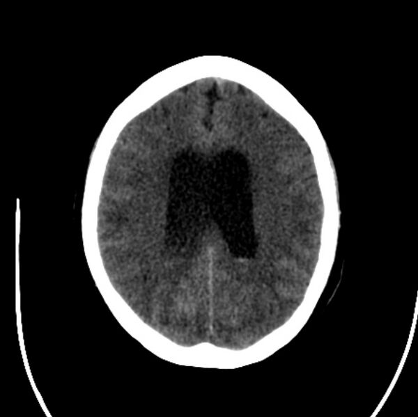 File:Cerebellar hemorrhage causing obstructive hydrocephalus (Radiopaedia 33989-35207 Axial non-contrast 34).jpg