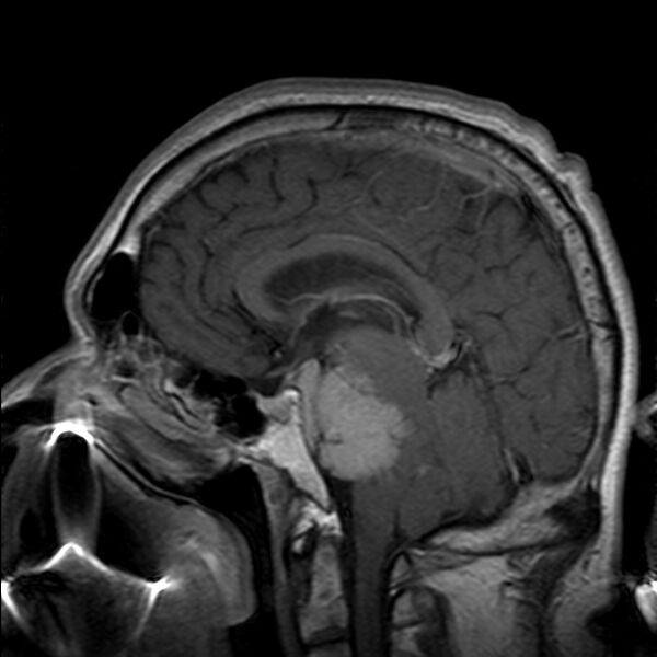 File:Cerebellopontine angle meningioma (Radiopaedia 24459-24764 Sagittal T1 C+ 13).jpg