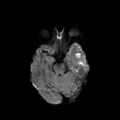 Cerebral abscess post cardiac surgery (Radiopaedia 27244-27420 Axial DWI 5).jpg