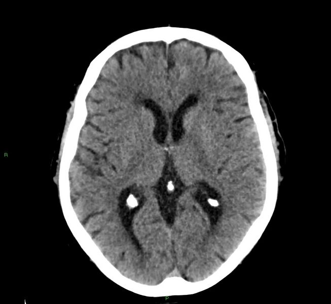 File:Cerebral amyloid angiopathy-associated lobar intracerebral hemorrhage (Radiopaedia 58376-65511 Axial non-contrast 30).jpg