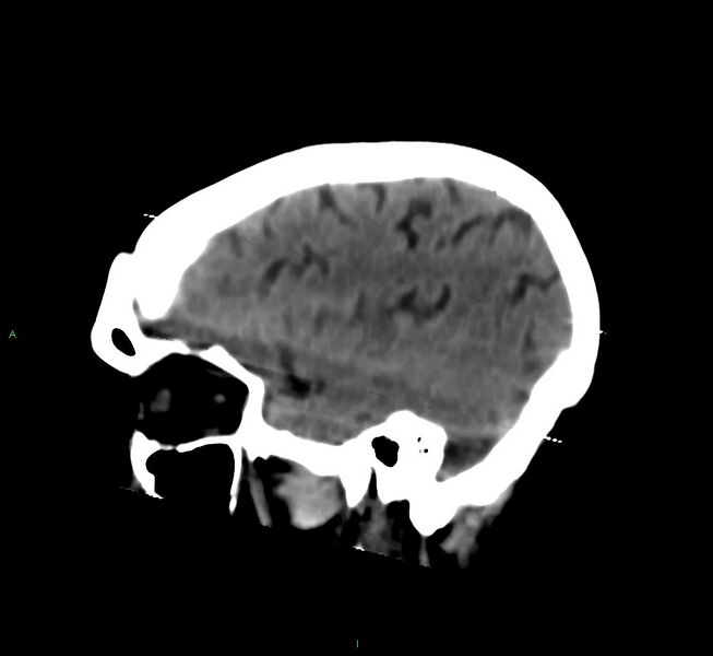File:Cerebral amyloid angiopathy-associated lobar intracerebral hemorrhage (Radiopaedia 58377-65514 B 39).jpg